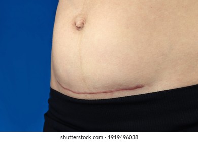 woman belly with a scar from a cesarean section close up