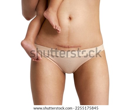 Woman belly with a scar from a cesarean section with her baby's legs on white background                                      Imagine de stoc © 