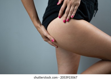 Woman In Black Shorts Shows The Hip And Thigh,real Skin On Buttocks, Stretch Marksov Er Gray Background. Skin Care.