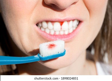 Woman With Bleeding Gums During Teeth Brushing. Hard Toothbrush Problem. Periodontal Disease, Avitaminosis, Gingivitis, Scurvy