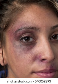 Woman with body facial injuries which can represent wife physical abuse, victim of crime and assault, or accident.  The injuries in the image are real from a biking accident.