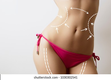 woman body with marks on stomach
