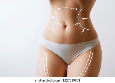 woman body with marks on stomach