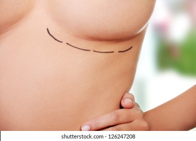 Woman Breast Marked Out For Cosmetic Surgery.