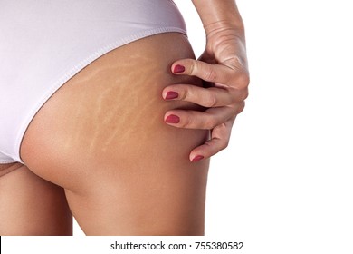 Woman buttocks with visible stretch marks and cellulite