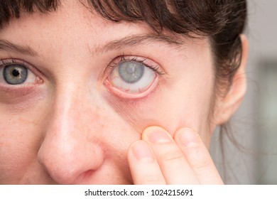 Woman With Cataract On Eye And Corneal Opacity