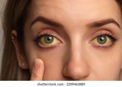 Woman checking her health condition, closeup. Yellow eyes as symptom of problems with liver - Shutterstock ID 2209463889