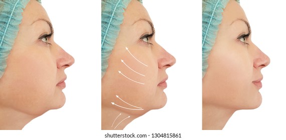 woman chin lift before and after procedures