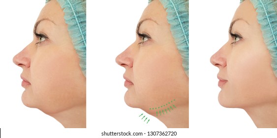 Woman Chin Lift Before And After Procedures