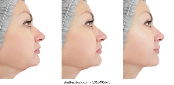 woman chin lift before and after procedures