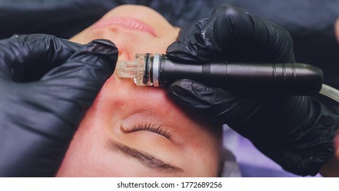 Woman Cleaning Nose Skin Pores Using Vacuum Blackhead Remover, Cosmetic Procedure.