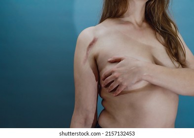 Woman Covers Chest With Arm, Scar On Top Of Shoulder