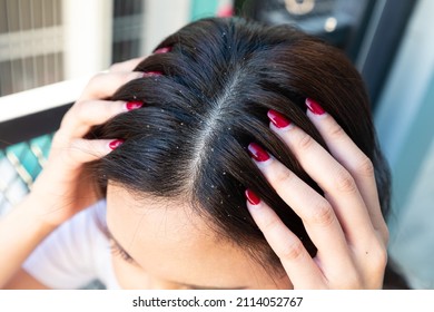 Woman With Dandruff In Her Dark Hair. Itchy Head Scalp And Dandruff Problem.