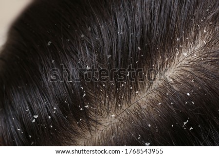 Woman with dandruff in her dark hair, closeup view Foto stock © 