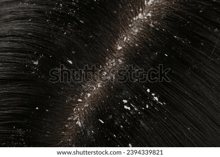 Woman with dandruff in her dark hair, closeup view Foto stock © 