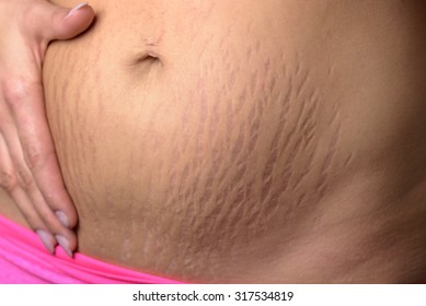 Woman displaying stretch marks on her abdomen after pregnancy caused by tearing of the dermis layer of the skin and showing as red discolorations, close up of her belly