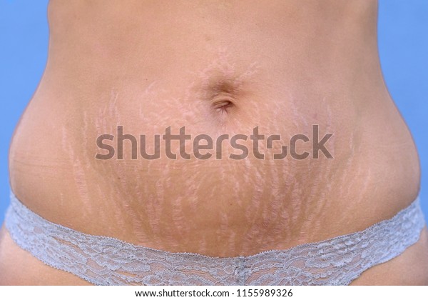 皮膚の真皮層の裂け目によって妊娠後に腹部に伸びの跡が付き 赤い変色として示され 腹の接写 の写真素材 今すぐ編集
