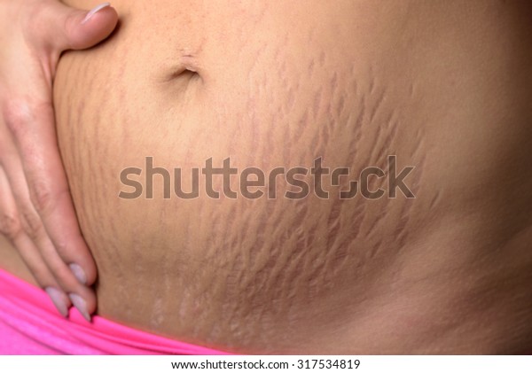 Woman displaying\
stretch marks on her abdomen after pregnancy caused by tearing of\
the dermis layer of the skin and showing as red discolorations,\
close up of her belly