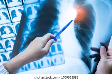 Woman Doctor Compare Patient Chest X-ray And CT Scan Film Before Treatment.Image Lung At Radiology Department In Hospital.Covid-19 Scan Body Xray Test Detection For Covid Virus Epidemic Spread Concept