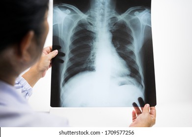 Woman Doctor Hands Holding Patient Chest X-ray Film Before Treatment.Image Lung At Radiology Department In Hospital.Covid-19 Scan Body Xray Test Detection For Covid Virus Epidemic Spread Concept.