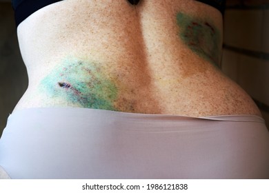 Woman With Dog Bite Marks On Her Body