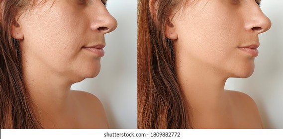 Woman Double Chin   After Treatment
