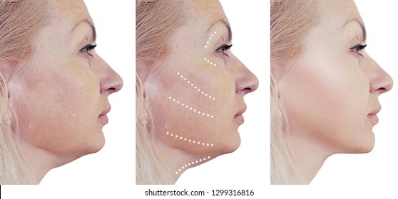 woman double chin before and after procedures