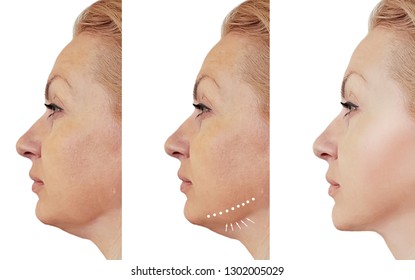Woman Double Chin Before And After Procedures
