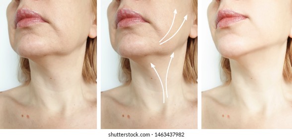 Woman Double Chin Before And After Treatment