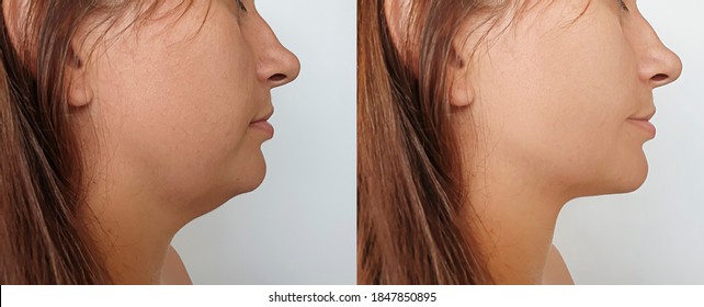 Woman Double Chin Before And After Treatment