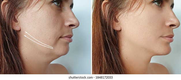 woman double chin before and after treatment