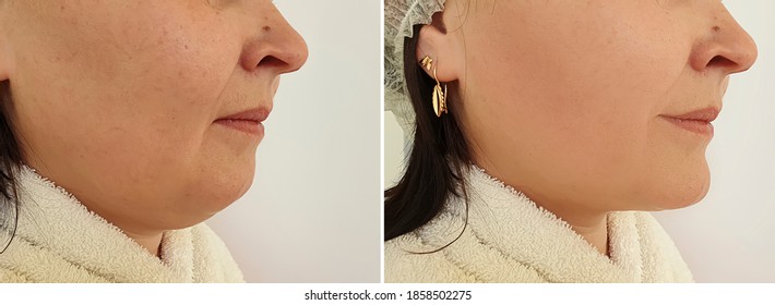 Woman Double Chin Before After Treatment Stock Photo 1858502275