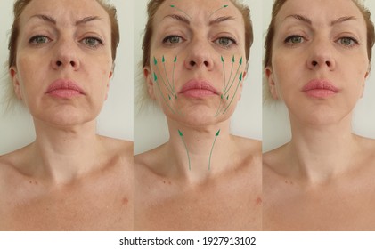 Woman Double Chin Before And After Treatment