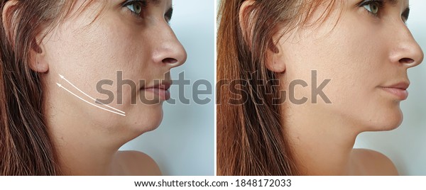 woman double chin\
before and after\
treatment