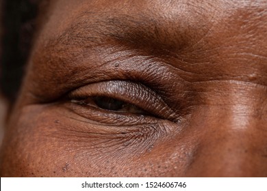 Woman With Drooping Eyelid, Symptoms Of Congenital Palpebular Ptosis