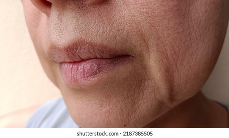 A Woman With Dry Scaly Skin In Her Mouth.