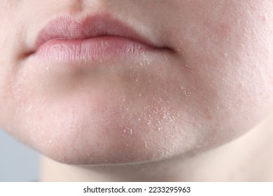 Woman with dry skin on face against light grey background, closeup - Shutterstock ID 2233295963