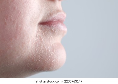 Woman with dry skin on face against light grey background, closeup. Space for text