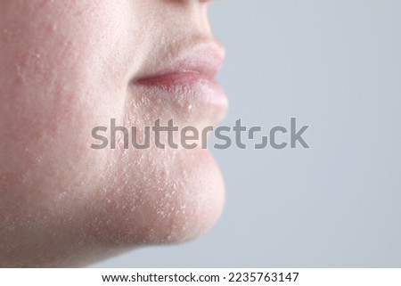 Woman with dry skin on face against light grey background, closeup. Space for text