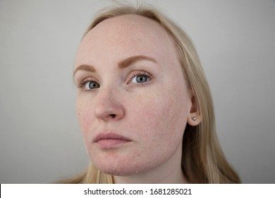 A Woman Examines Dry Skin On Her Face. Peeling, Coarsening, Discomfort, Skin Sensitivity. Patient At The Appointment Of A Dermatologist Or Cosmetologist, Selection Of Cream For Dryness