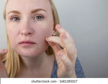 A Woman Examines Dry Skin On Her Face. Peeling, Coarsening, Discomfort, Skin Sensitivity. Patient At The Appointment Of A Dermatologist Or Cosmetologist, Selection Of Cream For Dryness