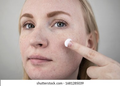 A Woman Examines Dry Skin On Her Face. Peeling, Coarsening, Discomfort, Skin Sensitivity. Patient At The Appointment Of A Dermatologist Or Cosmetologist, Selection Of Cream For Dryness