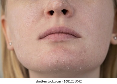 Eine Frau untersucht trockene Haut auf ihrem Gesicht. Peeling, Grobheit, Unwohlsein, Hautempfindlichkeit. Patient bei der Ernennung eines Dermatologen oder Kosmetologen, Auswahl der Creme für Trockenheit