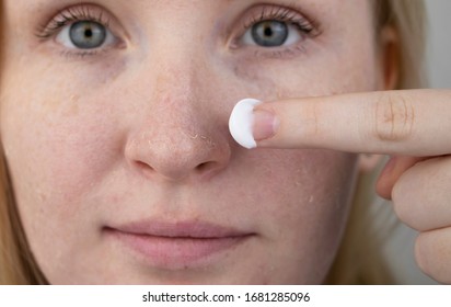 A Woman Examines Dry Skin On Her Face. Peeling, Coarsening, Discomfort, Skin Sensitivity. Patient At The Appointment Of A Dermatologist Or Cosmetologist, Selection Of Cream For Dryness