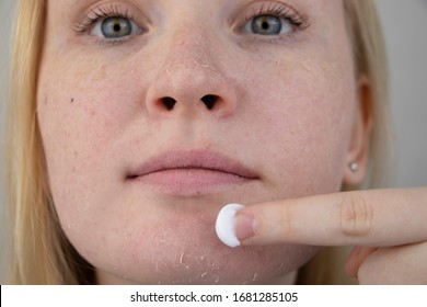 A Woman Examines Dry Skin On Her Face. Peeling, Coarsening, Discomfort, Skin Sensitivity. Patient At The Appointment Of A Dermatologist Or Cosmetologist, Selection Of Cream For Dryness