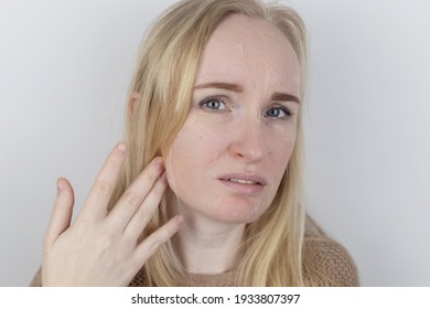 A Woman Examines Dry Skin On Her Face. Peeling, Coarsening, Discomfort, Skin Sensitivity. Patient At The Appointment Of A Dermatologist Or Cosmetologist. Close-up Of Pieces Of Dry Skin