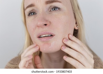 A Woman Examines Dry Skin On Her Face. Peeling, Coarsening, Discomfort, Skin Sensitivity. Patient At The Appointment Of A Dermatologist Or Cosmetologist. Close-up Of Pieces Of Dry Skin