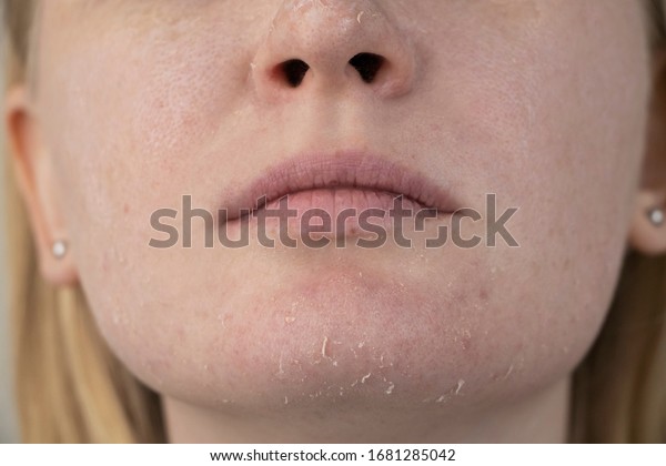 A woman examines dry skin on her face. Peeling,
coarsening, discomfort, skin sensitivity. Patient at the
appointment of a dermatologist or cosmetologist, selection of cream
for dryness