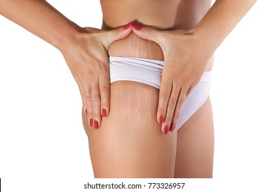 Woman examining her stretch marks on hips and thigh 