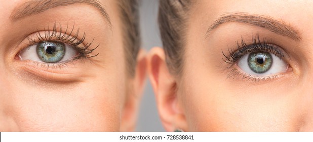 Woman Eye Bags Before And After Cosmetic Treatment